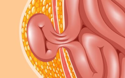 Hernia Surgery in Ravet: Types, Treatment, and Recovery Time