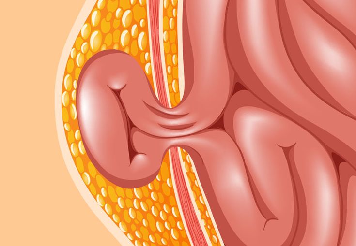 Hernia Surgery