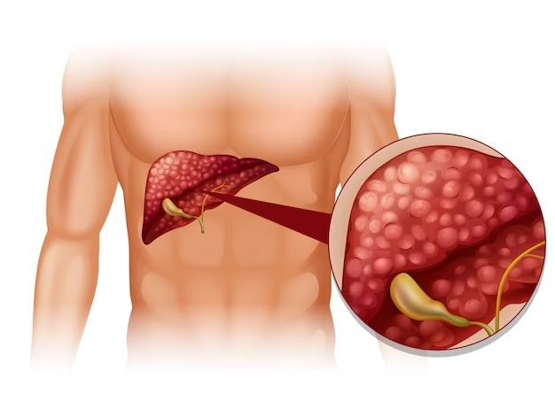 Gallbladder Stone Surgery: Laparoscopic vs Open Surgery in Ravet